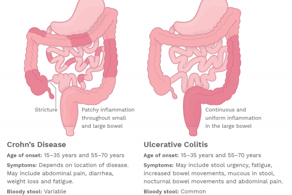 Source: https://www.crohnscolitisfoundation.org/what-is-crohns-disease/overview